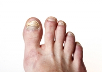 Does Laser Treatment for Toenail Fungus Work?