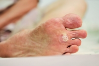 How Can I Get Rid of Warts on My Feet?