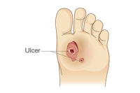 Classifications of Diabetic Foot Ulcers
