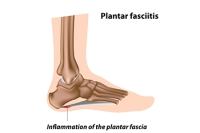 Incorrect Shoes and Walking Barefoot May Cause Plantar Fasciitis