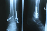 What Are the Different Types of Fractures?