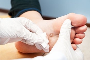 Plantar Warts and Bed Sheets