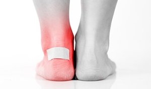 Treating a Blister